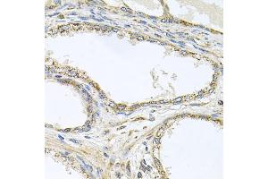 Immunohistochemistry of paraffin-embedded human prostate using TNFRSF10A antibody (ABIN5973697) at dilution of 1/100 (40x lens). (TNFRSF10A Antikörper)