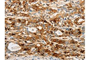 The image on the left is immunohistochemistry of paraffin-embedded Human gastic cancer tissue using ABIN7130484(OASL Antibody) at dilution 1/20, on the right is treated with fusion protein. (OASL Antikörper)