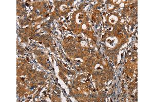 Immunohistochemistry of Human thyroid cancer using CEACAM3 Polyclonal Antibody at dilution of 1:30