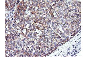 Immunohistochemical staining of paraffin-embedded Adenocarcinoma of Human ovary tissue using anti-NMT2 mouse monoclonal antibody. (NMT2 Antikörper)