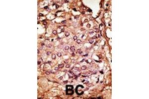 Formalin-fixed and paraffin-embedded human cancer tissue reacted with the primary antibody, which was peroxidase-conjugated to the secondary antibody, followed by AEC staining. (CCBP2 Antikörper  (AA 54-84))