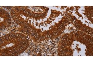 Immunohistochemistry of paraffin-embedded Human colon cancer tissue using MFAP3L Polyclonal Antibody at dilution 1:50