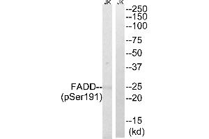 Immunohistochemistry analysis of paraffin-embedded human breast carcinoma tissue, using FADD (Phospho-Ser191) antibody. (FADD Antikörper  (pSer191))