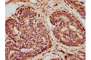 IHC image of ABIN7170979 diluted at 1:100 and staining in paraffin-embedded human breast cancer performed on a Leica BondTM system. (SOD1 Antikörper  (AA 2-154))