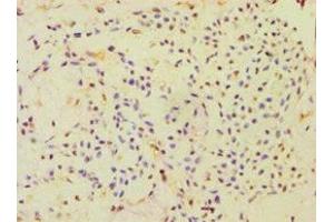 Immunohistochemistry of paraffin-embedded human breast cancer using ABIN7151000 at dilution of 1:100 (CBLC Antikörper  (AA 245-474))