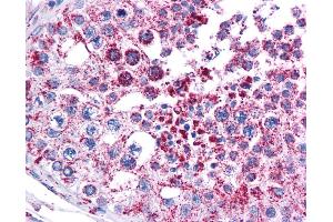 Immunohistochemistry (IHC) image for anti-Melanoma Antigen Family A, 3 (MAGEA3) (Middle Region) antibody (ABIN2782498) (MAGEA3 Antikörper  (Middle Region))