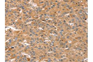 The image on the left is immunohistochemistry of paraffin-embedded Human liver cancer tissue using ABIN7128752(CAPN7 Antibody) at dilution 1/20, on the right is treated with fusion protein. (Calpain 7 Antikörper)