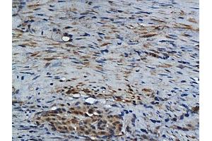 Formalin-fixed and paraffin embedded human colon carcinoma labeled with Rabbit Anti GM-CSF Polyclonal Antibody, Unconjugated (ABIN704156) at 1:200 followed by conjugation to the secondary antibody and DAB staining