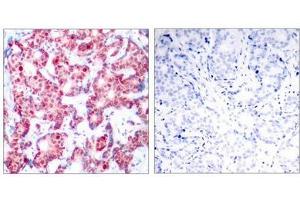 Immunohistochemical analysis of paraffin-embedded human breast carcinoma tissue using GATA1(Phospho-Ser142) Antibody(left) or the same antibody preincubated with blocking peptide(right). (GATA1 Antikörper  (pSer142))