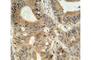 ABCC3 antibody immunohistochemistry analysis in formalin fixed and paraffin embedded human colon carcinoma.