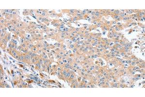 Immunohistochemistry of paraffin-embedded Human gastric cancer using WNT3A Polyclonal Antibody at dilution of 1:40 (WNT3A Antikörper)