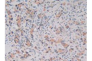 IHC-P analysis of Human Prostate Gland Cancer Tissue, with DAB staining. (Kallikrein 2 Antikörper  (AA 19-261))