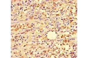 Immunohistochemistry of paraffin-embedded human gastric cancer using ABIN7144964 at dilution of 1:100 (PIF1 Antikörper  (AA 125-360))
