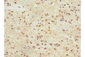 Immunohistochemistry of paraffin-embedded human glioma using ABIN7163952 at dilution of 1:100 (KCNA3 Antikörper  (AA 486-575))