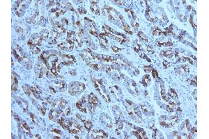 Formalin-fixed, paraffin-embedded human Gastric Carcinoma stained with MUC6 Mouse Monoclonal Antibody (CLH5). (MUC6 Antikörper)