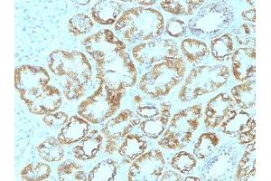 Formalin-fixed, paraffin-embedded human Renal Cell Carcinoma stained with Laminin Monoclonal Antibody (SPM193).