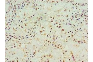Immunohistochemistry of paraffin-embedded human breast cancer using ABIN7144000 at dilution of 1:100 (Aminoacylase 1 Antikörper  (AA 1-408))
