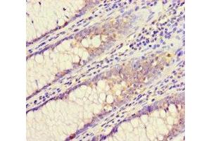 Immunohistochemistry of paraffin-embedded human colon cancer using ABIN7147525 at dilution of 1:100 (CHMP4C Antikörper  (AA 1-233))