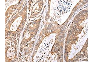 The image on the left is immunohistochemistry of paraffin-embedded Human colorectal cancer tissue using ABIN7193077(XKR7 Antibody) at dilution 1/20, on the right is treated with synthetic peptide. (XKR7 Antikörper)