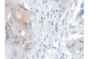 DAB staining on IHC-P; Samples: Human Breast cancer Tissue (Kallikrein 14 Antikörper  (AA 36-267))