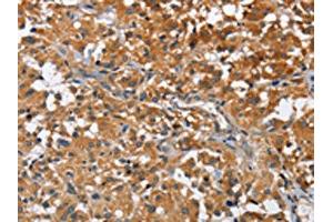 The image on the left is immunohistochemistry of paraffin-embedded Human thyroid cancer tissue using ABIN7128585(ATP1B2 Antibody) at dilution 1/30, on the right is treated with fusion protein. (ATP1B2 Antikörper)