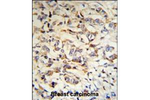 CPN2 Antibody (RB18703) IHC analysis in formalin fixed and paraffin embedded human breast carcinoma tissue followed by peroxidase conjugation of the secondary antibody and DAB staining. (CPN2 Antikörper  (N-Term))