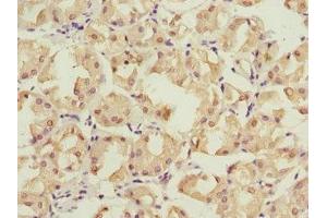 Immunohistochemistry of paraffin-embedded human gastric cancer using ABIN7142206 at dilution of 1:100
