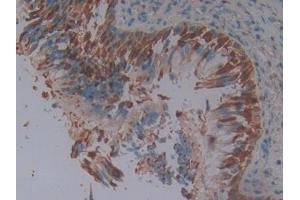 DAB staining on IHC-P; Samples: Human Lung cancer Tissue (SERPINB3 Antikörper  (AA 1-210))