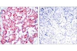 Immunohistochemistry analysis of paraffin-embedded human breast carcinoma, using GATA1 (Phospho-Ser142) Antibody.