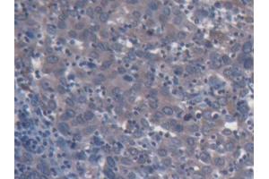 IHC-P analysis of Human Endometrial cancer Tissue, with DAB staining. (CD131 Antikörper  (AA 133-233))