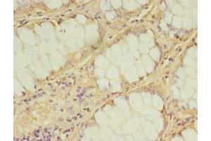 Immunohistochemistry of paraffin-embedded human breast cancer using ABIN7157126 at dilution of 1:100 (IPP Isomerase 2 Antikörper  (AA 1-227))