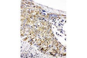 Anti-Prohibitin antibody, IHC(P) IHC(P): Human Lung Cancer Tissue (Prohibitin Antikörper  (C-Term))