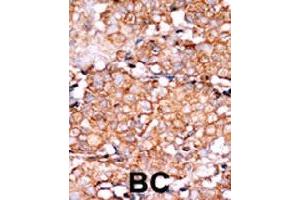 Formalin-fixed and paraffin-embedded human cancer tissue reacted with RAD9A (phospho S328) polyclonal antibody  which was peroxidase-conjugated to the secondary antibody followed by AEC staining.