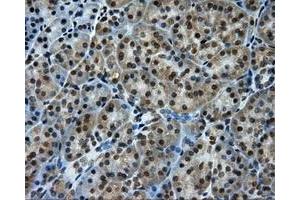 Immunohistochemical staining of paraffin-embedded Carcinoma of liver tissue using anti-PTPRE mouse monoclonal antibody. (PTPRE Antikörper)