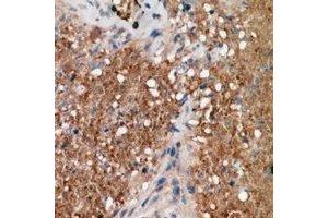 Immunohistochemical analysis of ALPK1 staining in human breast cancer formalin fixed paraffin embedded tissue section. (ALPK1 Antikörper  (N-Term))