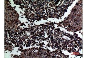 Immunohistochemistry (IHC) analysis of paraffin-embedded Human Lung Cancer, antibody was diluted at 1:100.