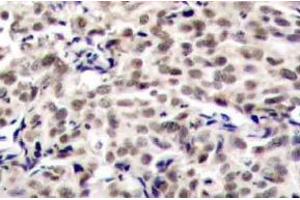 Immunohistochemistry (IHC) analyzes of CREB antibody in paraffin-embedded human breast carcinoma tissue. (CREB1 Antikörper)