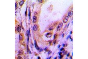 Immunohistochemical analysis of Thrombospondin 4 staining in human lung cancer formalin fixed paraffin embedded tissue section. (THBS4 Antikörper)
