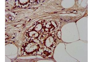 IHC image of ABIN7147581 diluted at 1:300 and staining in paraffin-embedded human breast cancer performed on a Leica BondTM system. (CLCNKB Antikörper  (AA 538-687))