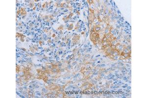 Immunohistochemistry of Human cervical cancer using ADRB3 Polyclonal Antibody at dilution of 1:60 (ADRB3 Antikörper)