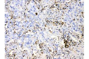DHODH was detected in paraffin-embedded sections of human lung cancer tissues using rabbit anti- DHODH Antigen Affinity purified polyclonal antibody (Catalog # ) at 1 µg/mL. (DHODH Antikörper  (N-Term))
