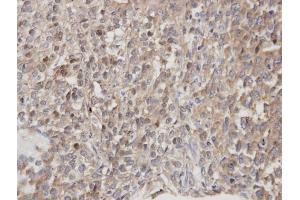IHC-P Image Immunohistochemical analysis of paraffin-embedded human lung cancer, using DOCK 180 , antibody at 1:100 dilution. (DOCK1 Antikörper  (C-Term))