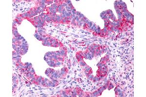 Anti-P2RY8 / P2Y8 antibody IHC of human Ovary, Carcinoma. (P2RY8 Antikörper  (Cytoplasmic Domain))