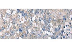 Immunohistochemistry of paraffin-embedded Human liver cancer tissue using HPCAL1 Polyclonal Antibody at dilution of 1:70(x200)