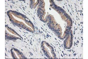 Immunohistochemical staining of paraffin-embedded Adenocarcinoma of Human colon tissue using anti-BAIAP2 mouse monoclonal antibody. (BAIAP2 Antikörper)