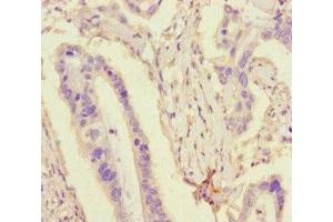 Immunohistochemistry of paraffin-embedded human pancreatic cancer using ABIN7173764 at dilution of 1:100 (TDRD3 Antikörper  (AA 401-651))