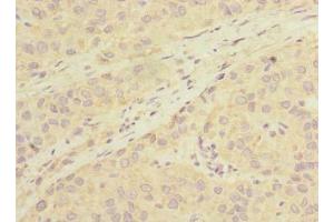 Immunohistochemistry of paraffin-embedded human liver cancer using ABIN7163378 at dilution of 1:100 (LHPP Antikörper  (AA 1-270))