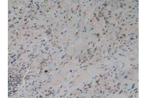 IHC-P analysis of Human Glioma Tissue, with DAB staining. (Gelsolin Antikörper  (AA 577-771))