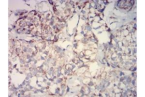 Immunohistochemical analysis of paraffin-embedded bladder cancer tissues using IDH2 mouse mAb with DAB staining. (IDH2 Antikörper  (AA 1-143))