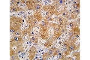 IHC analysis of FFPE human hepatocarcinoma tissue stained with APOA4 antibody (APOA4 Antikörper  (AA 49-79))